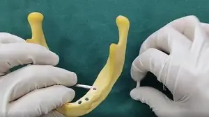 BLE Straight Abutment