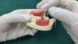 NT Open Tray Impression Post