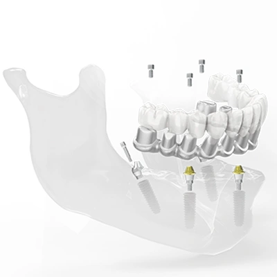 Dental Bridge (CAD/CAM Framework)