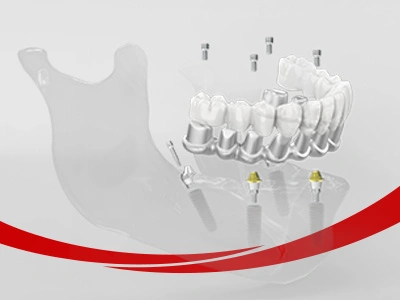 Dental Bridge (CAD/CAM Framework)