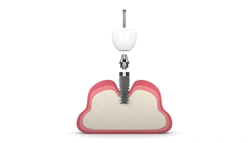 Implant Crown