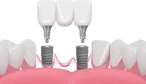 Implant Bridge