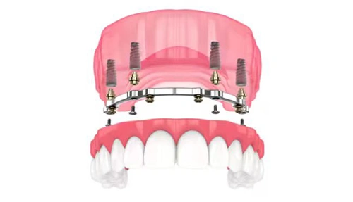 Implant Denture