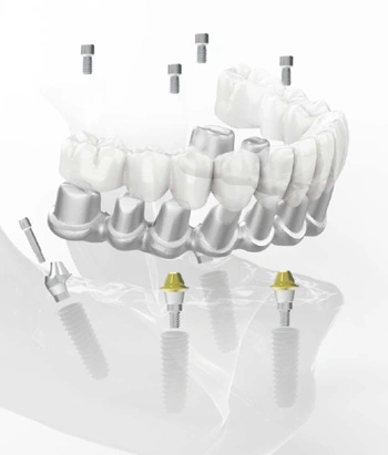 Trausim premill abutment