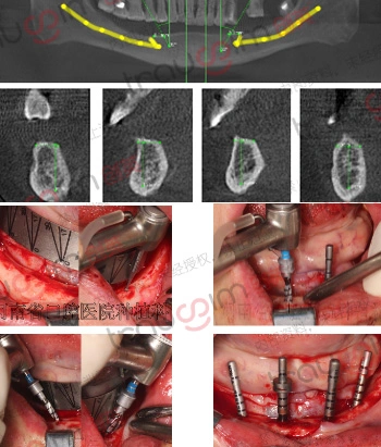 BLE Implant Clinical Case