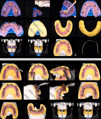 NT Implant Clinical Case