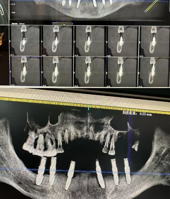 RS Implant Clinical Case